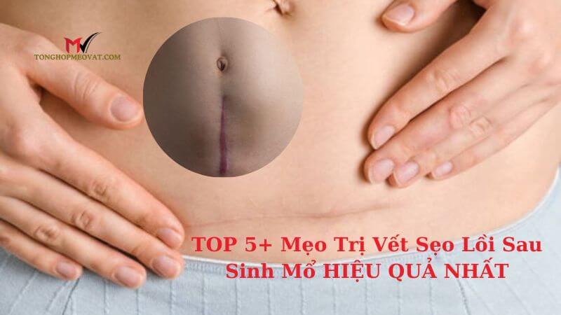 Mẹo Trị Vết Sẹo Lồi Sau Sinh Mổ HIỆU QUẢ NHẤT